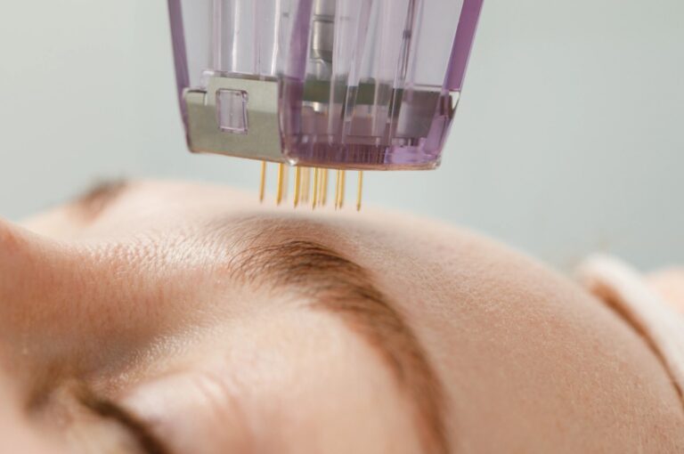 Micro-Needling-inside