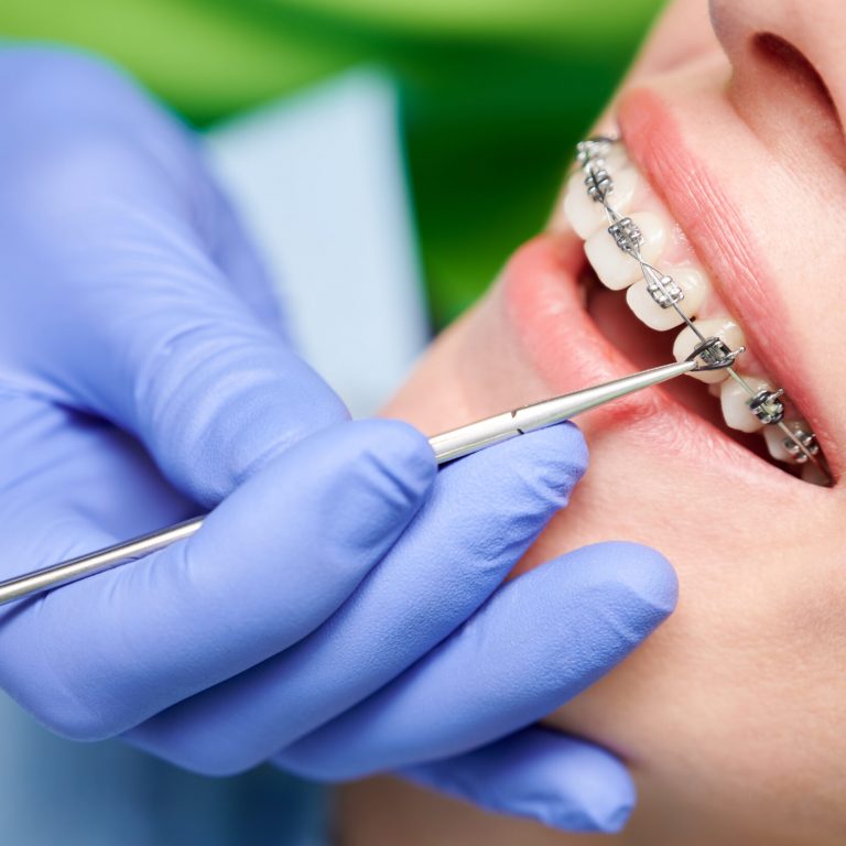 Close up of dentist hand using dental forceps while putting orthodontic braces on female patient teeth. Woman having dental procedure in clinic. Concept of dentistry and orthodontic treatment.