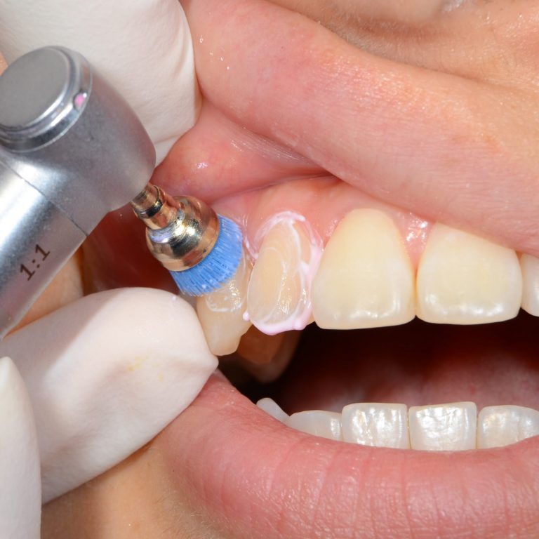 Scaling and Polishing inside picture