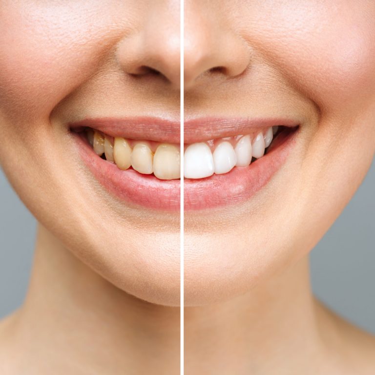 woman teeth before and after whitening. Over white background. Dental clinic patient. Image symbolizes oral care dentistry, stomatology